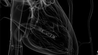 New wireless pacemaker shocks heart back into rhythm