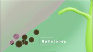 Gallbladder Inflammation (cholelithiasis with cholecystitis) Medical Animation