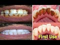 In just 2 Minutes - Turn Yellow Teeth to Pearl White With This Kitchen Ingredients amazing Teeth