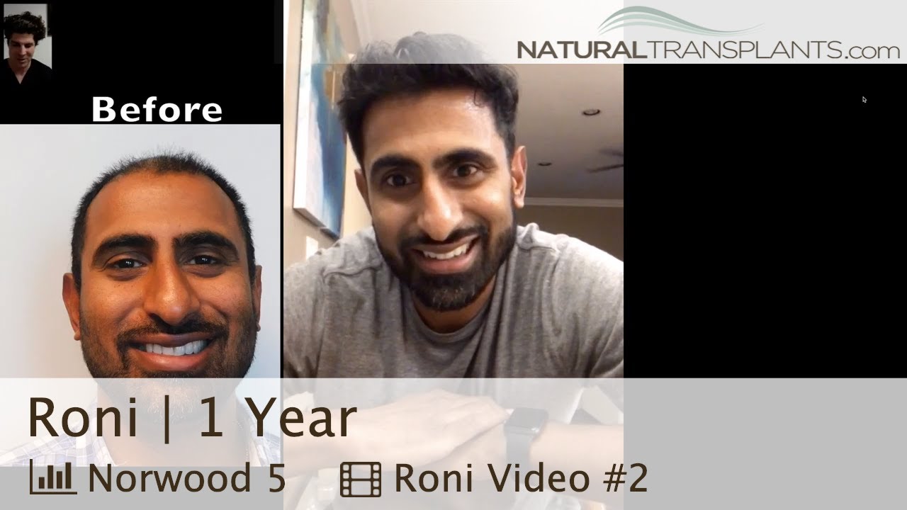 fue hair transplant month by month Hair Loss Treatment Before and After -