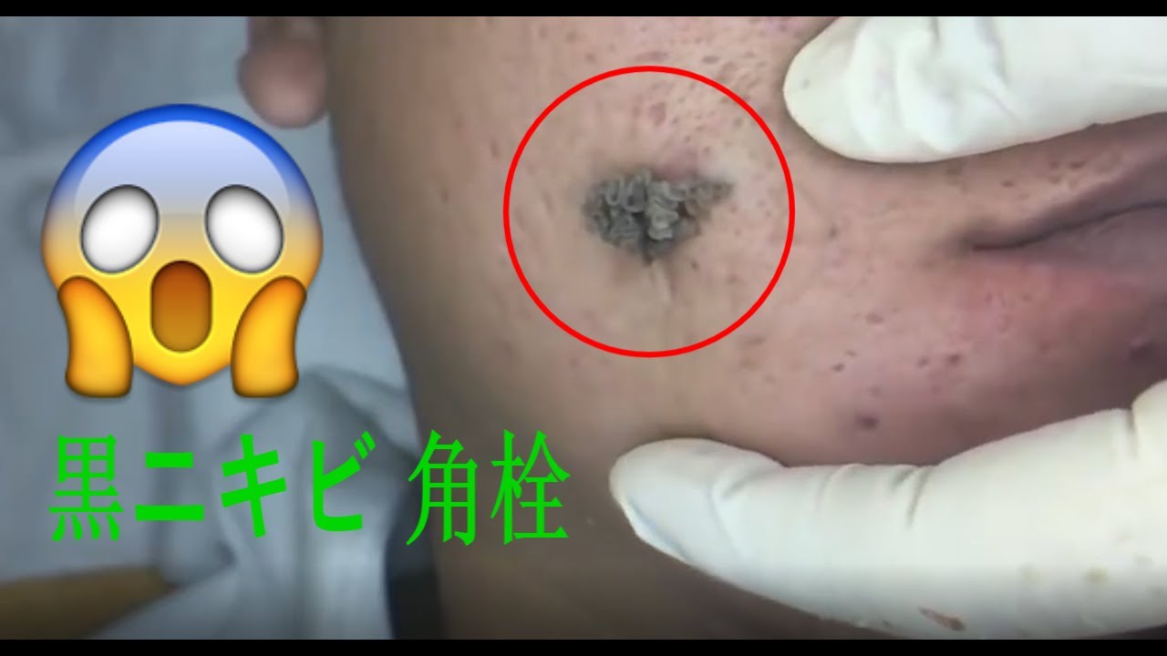 黒ニキビ 角栓 除去 ニキビ 芯出し 角栓 Cyst Blackheads Youtube