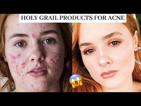 How I Cleared my Cystic Acne: HG Products