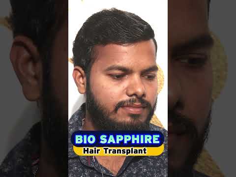 BIO Sapphire Hair Transplant In Hyderabad #hairtransplant #hairtransplantation #shorts