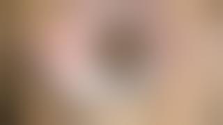 Trabeculectomy and Surgical Peripheral Iridectomy With Goniosynechialysis and Goniotomy in PACG