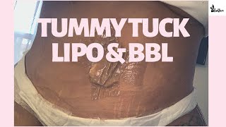Tummy Tuck Lipo Bbl At Home Care Recovery After Tt And Brazilian Butt Lift Combo