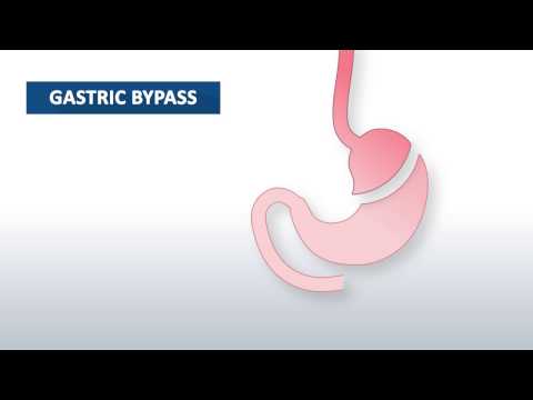 Video: Ce este bypassul gastric?