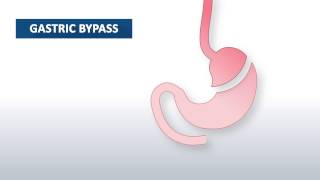 What Is Gastric Bypass Surgery? Beaumont Health