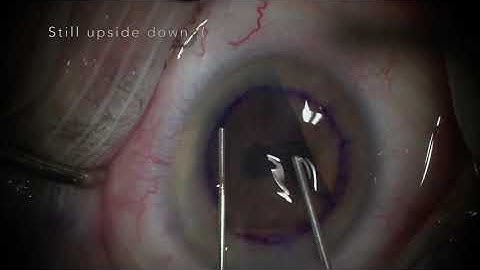 DMEK + Cataract Surgery - Flipping an upside down graft