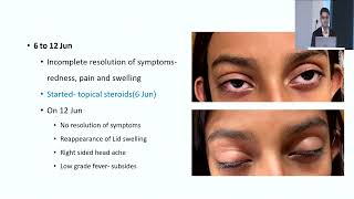 AIOC204 - GP198 - PG CAPSULE - OCULAR IMMUNOLOGY