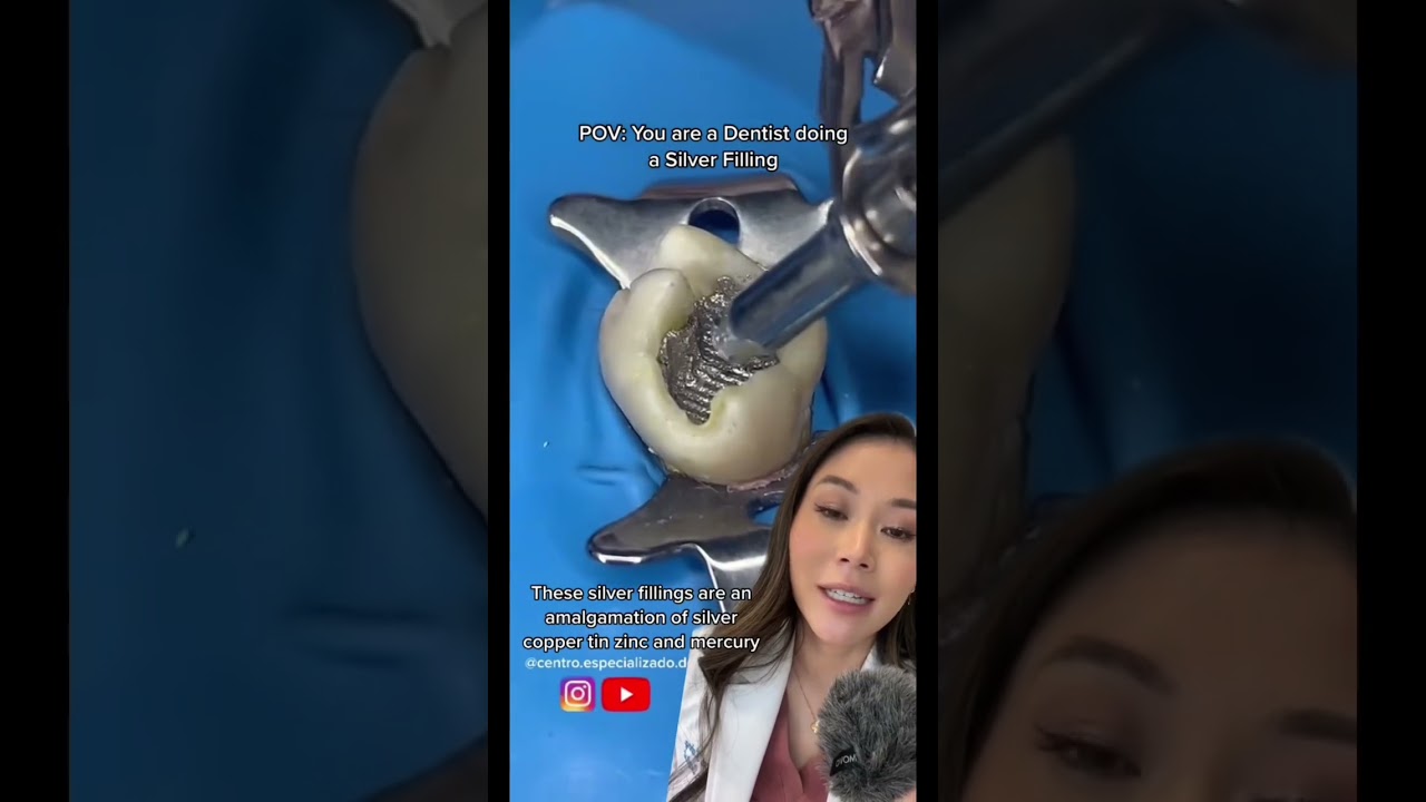 Silver dental filling. 