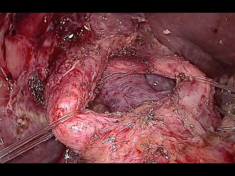 Laparoscopic completion radical cholecystectomy and lymphadenectomy for gallbladder cancer