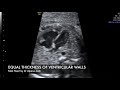 TMT: Fetal Heart 4Ch View (II) by Dr Alpana Joshi