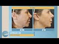 Ultherapy vs. Facelift: What's the Difference? | ABC 10News