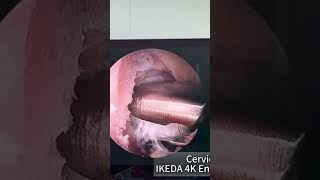 4K endoscope camera system-Cervical disc surgery