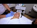 Aesthetica md spa   vampire facial