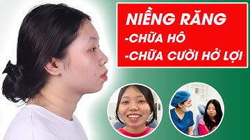 Gắn mắc cài niềng răng | Điều trị răng hô và chữa cười hở lợi bằng phương pháp niềng răng