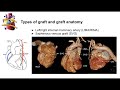 Role of cardiac CT in the evaluation of coronary stents and coronary artery by-pass grafts