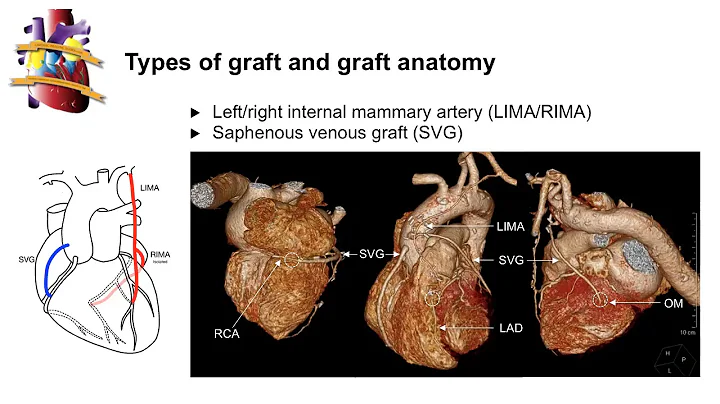 Role of cardiac CT in the evaluation of coronary stents and coronary artery by-pass grafts