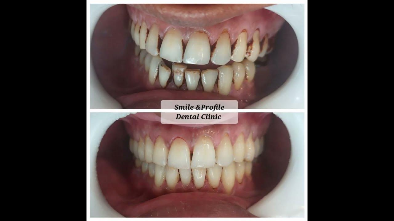 Remove gutka stains. dentist braces dentalcare teeth 