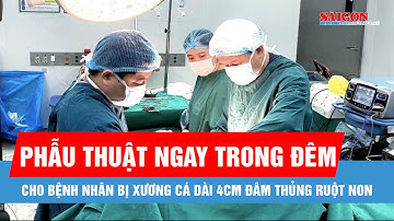 Xương cá đâm thủng ruột non gây áp xe ổ bụng