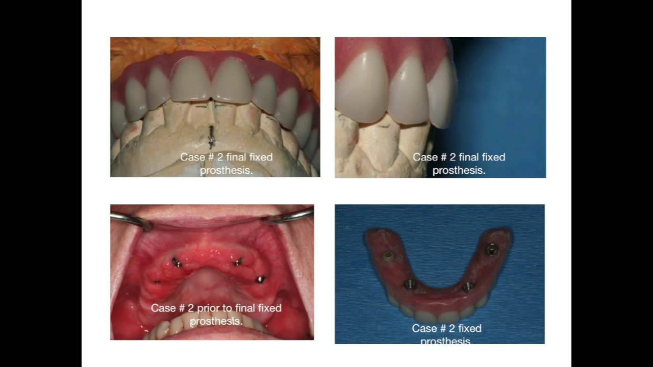 Teeth in One Day at Cascadia Dental Specialists YouTube