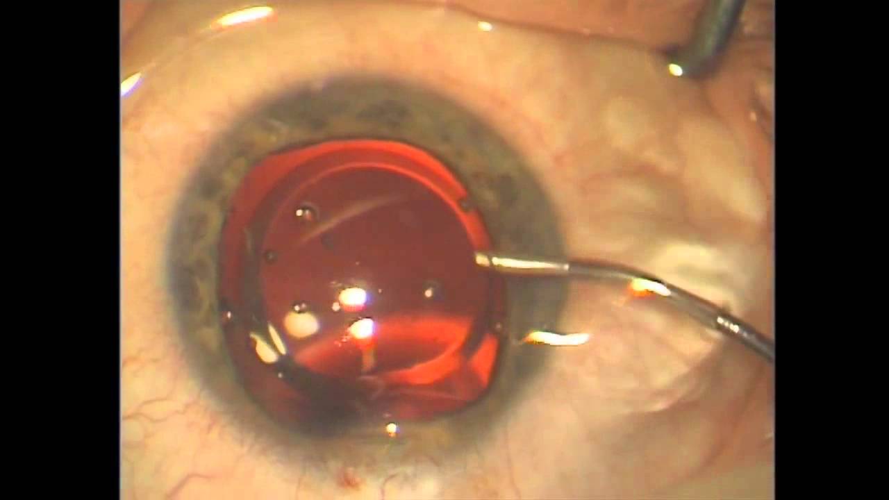 Имплантация факичной линзы PRL