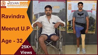 Ravindra is 32 years old young boy from Meerut lost his Right leg in a bike accident