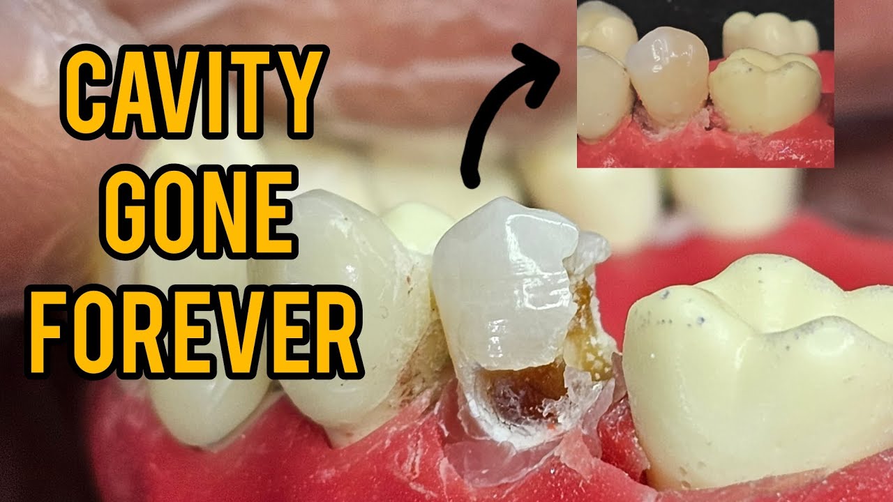 Removing A large Cavity and restoration