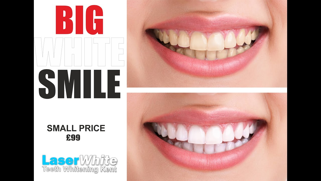 Teeth Whitening Tooth Whitening at LASERWHITE KENT YouTube