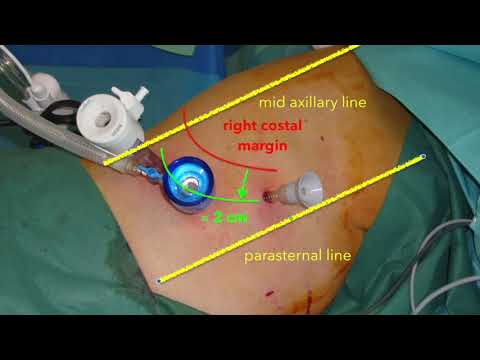 Diaphragmatic endometriosis - laparoscopic  treatment in 10 steps