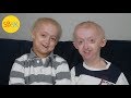 Brothers with the Same Rare Condition (Growing up with Progeria)