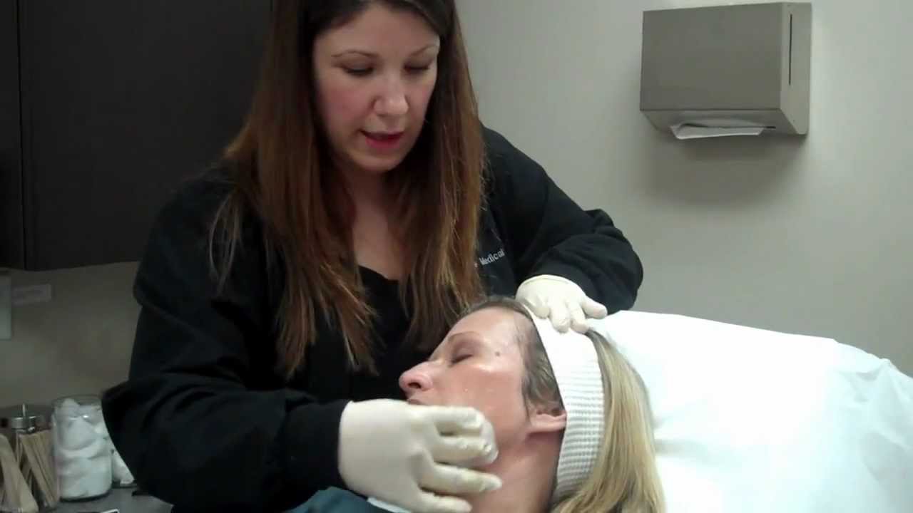 Chemical Peel Demo - Part 2 | Heights Laser Centre In Burnaby - YouTube