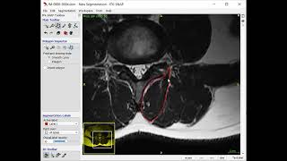 Lumbar Multifidus Segmentation in ITK SNAP
