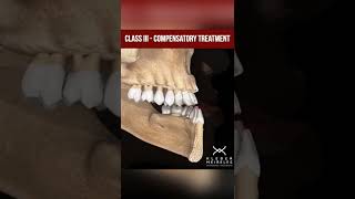 CLASS ||| - COMPENSATORY TREATMENT - ORTHODONTIC TIPS #Shorts