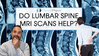 Are MRI Scans Always Helpful in the Diagnosis of Low Back Pain? | Expert Physio Reviews the Evidence Wealth