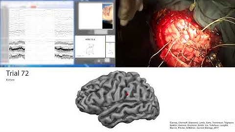 Mapping language ability during awake brain surgery