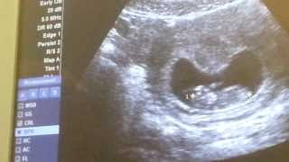 Ultrasound at 9 weeks! Baby moving like crazy!