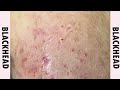 Relaxing Every day , Blackhead Removal 2025 , New Video blackhead remove