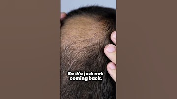 CAN DEAD HAIR FOLLICLES BE REVIVED? EXPLORING THE HOPE FOR HAIR REGROWTH