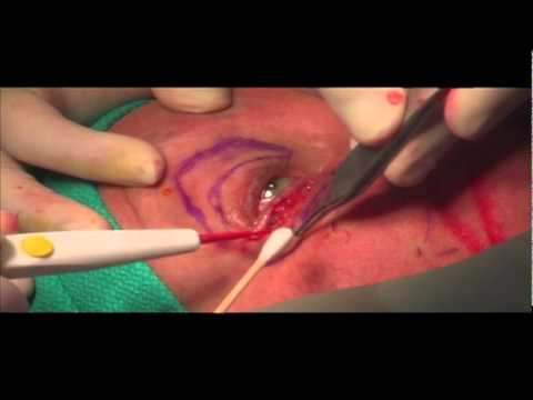 Miami Plastic Surgery - Blepharoplasty (Eyelid Surgery) Video With Dr. Michael Kelly