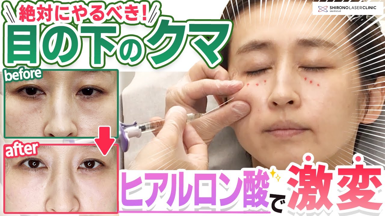 【目の下のクマ】凹みがふっくら！自然！若返りヒアルロン酸注射 ※施術動画
