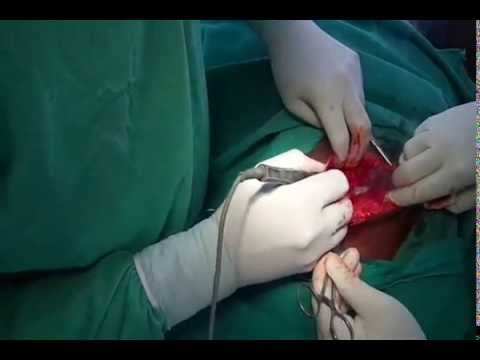 Open Cholecystectomy in Atrophied Gall Bladder gallbladder cancer