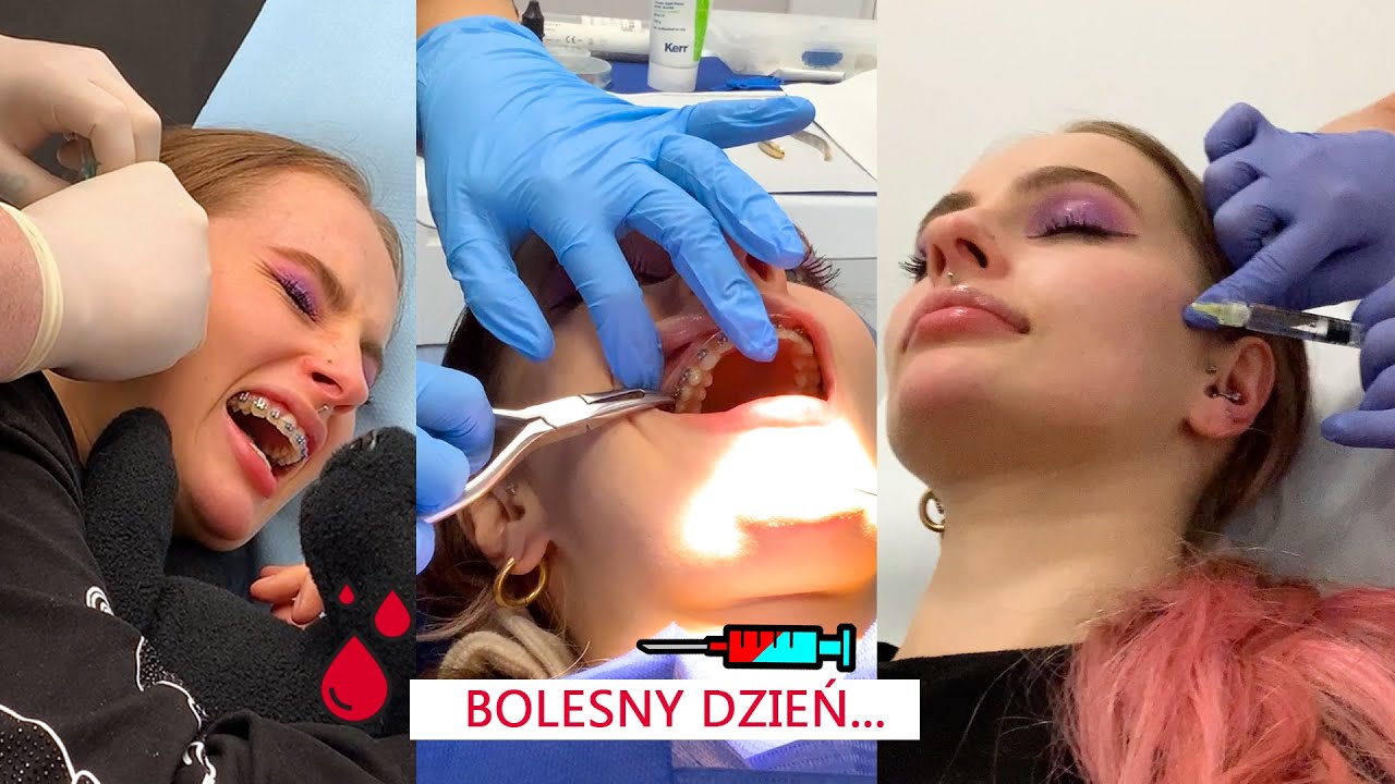 ROBIĘ 2 KOLCZYKI, ORTODONTA, LIFTING TWARZY I WARSZAWSKIE ZBOKI - VLOGMAS #1