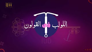 اللولب فى القولون