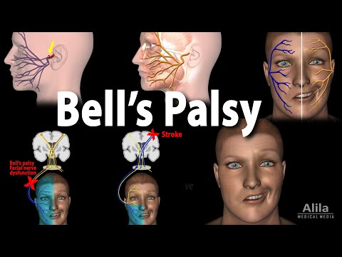 Bell&#39;s Palsy, Pathophysiology, Symptoms, Diagnosis and Treatment, Animation