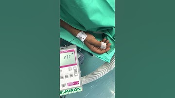 Neuromuscular Monitoring - Deep Block: Train of Four Count 0, Post-Tetanic Count 1 or More