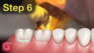 HOW TO  Cement Zirconia #Crown for Less Retentive Tooth Prep