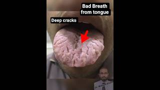 Fissured tongue #mbbs