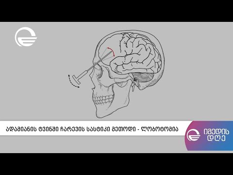 ადამიანის ტვინში ჩარევის სასტიკი მეთოდი - ლობოტომია