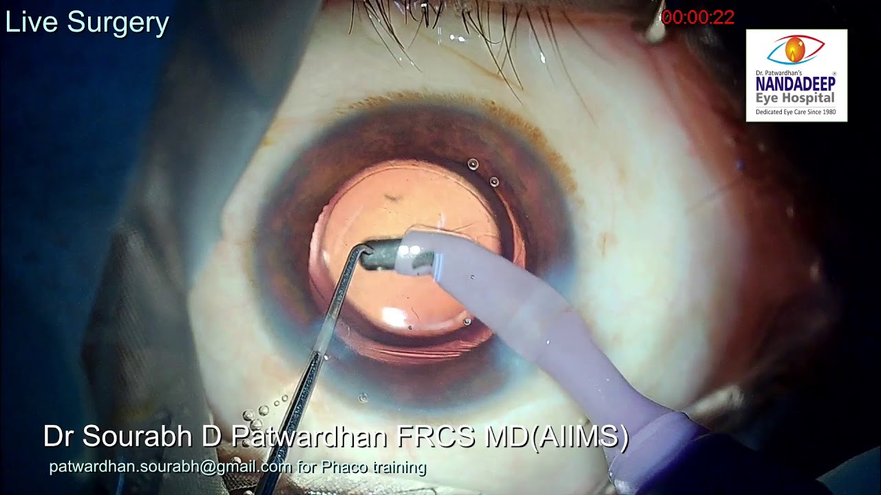Thin Lens Infiniti Eyhance Live surgery from Nandadeep Eye Hospital Dr Sourabh Patwardhan